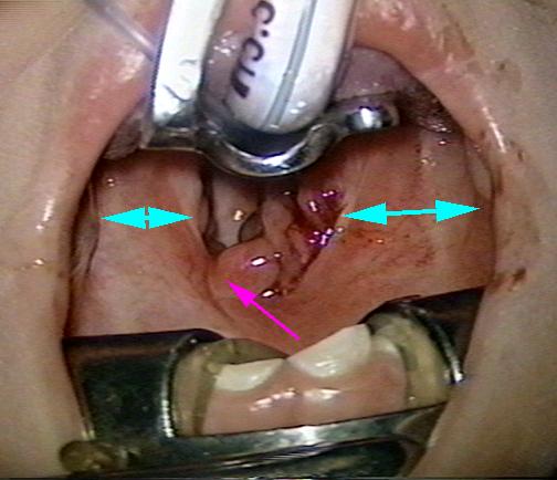 abscess in throat