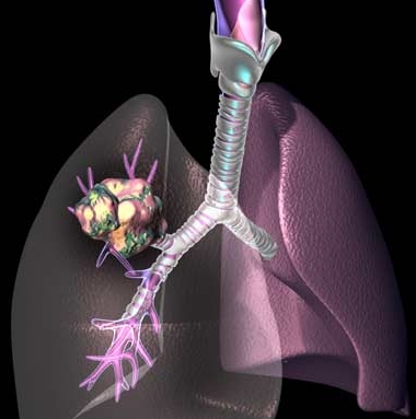 폐암 초기증상과 폐암증상은? 