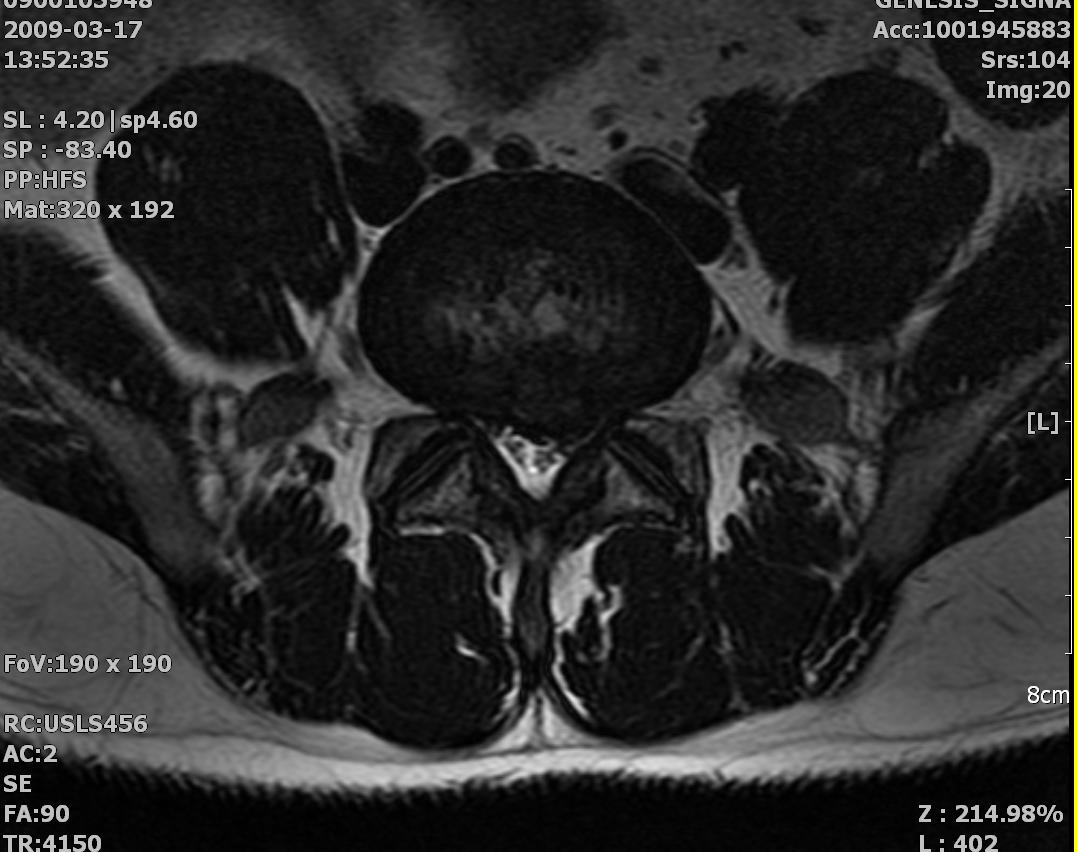 HNP : herniated nucleus pulposus, HIVD : herniated intervertebral disc - 카페
